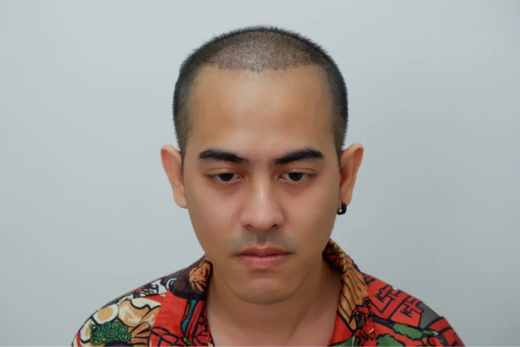 วิธีดูแลหลังปลูกผม 14 วัน