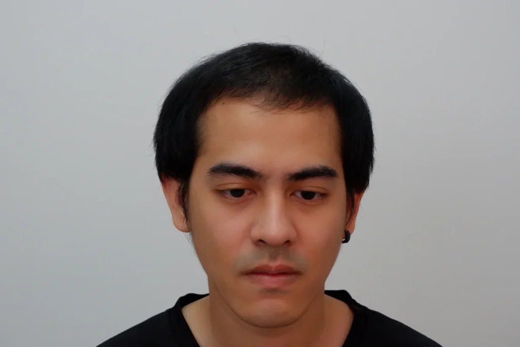 วิธีดูแลหลังปลูกผม 6 เดือน