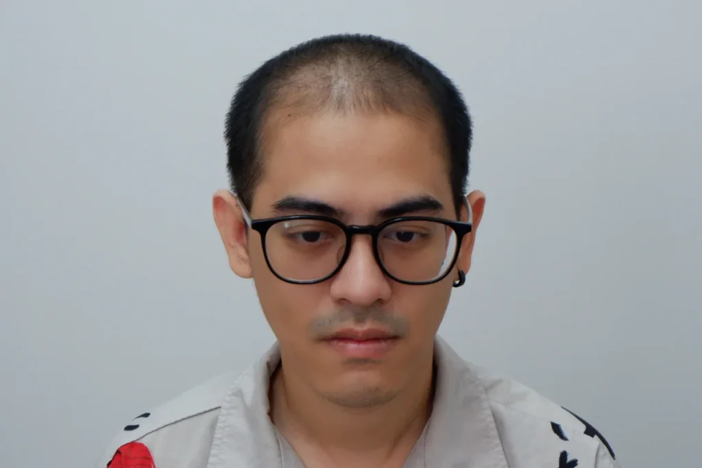 วิธีดูแลหลังปลูกผม 3-4 เดือน