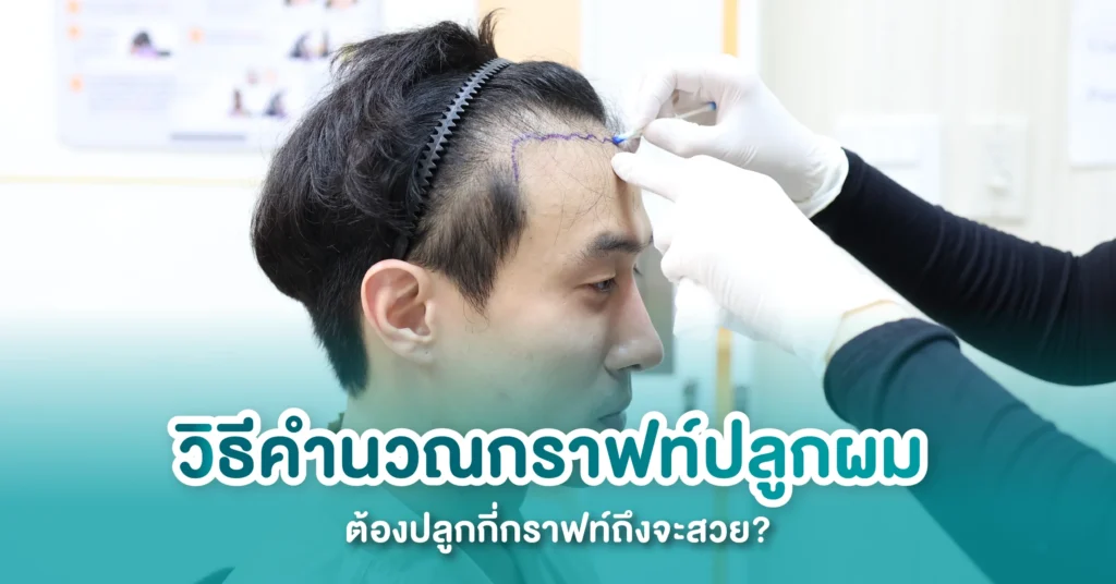คำนวณกราฟท์ผม ปลูกผมกี่กราฟท์ดี?