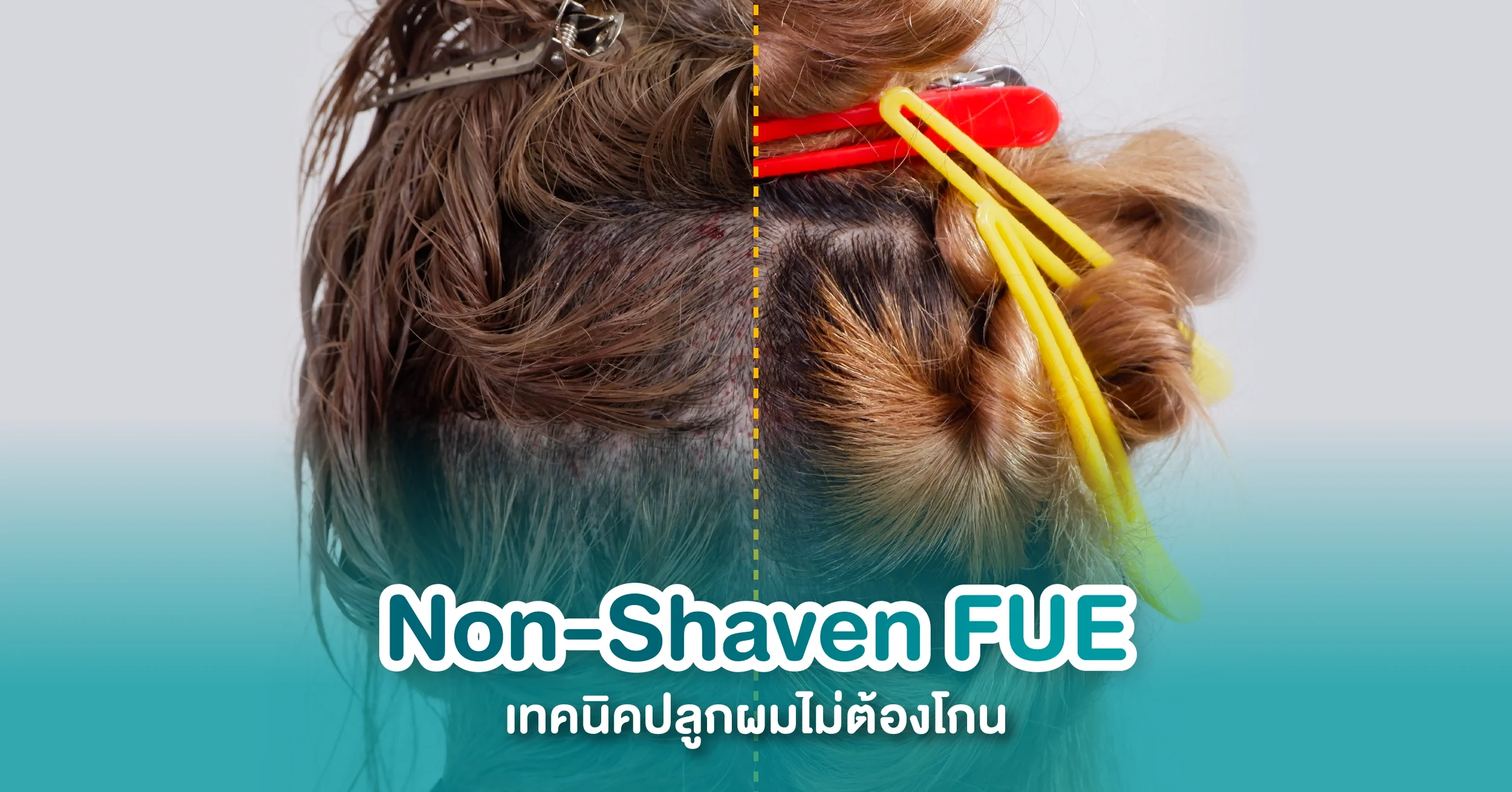 Non-Shaven FUE เทคนิคปลูกผมไม่โกน ราคาเท่าไหร่? รวมสิ่งที่ควรรู้