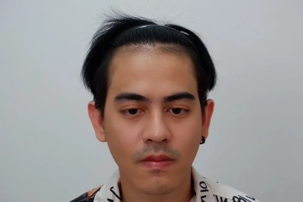 วิธีดูแลหลังปลูกผม 9-12 เดือน