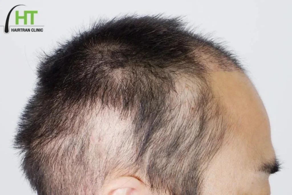 อาการที่อาจพบได้หลังปลูกผม