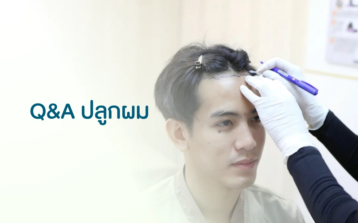 Q&A ปลูกผม