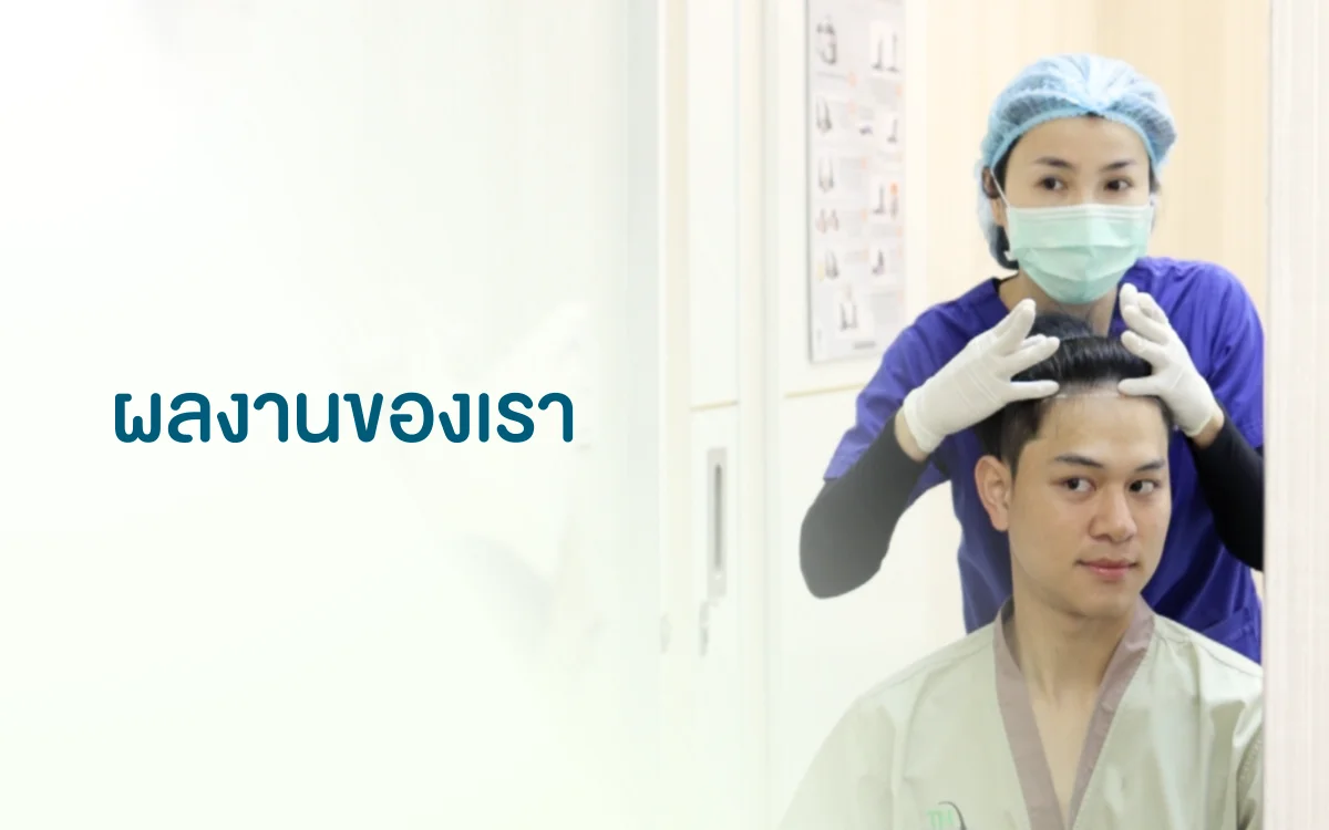 ผลงานปลูกผม