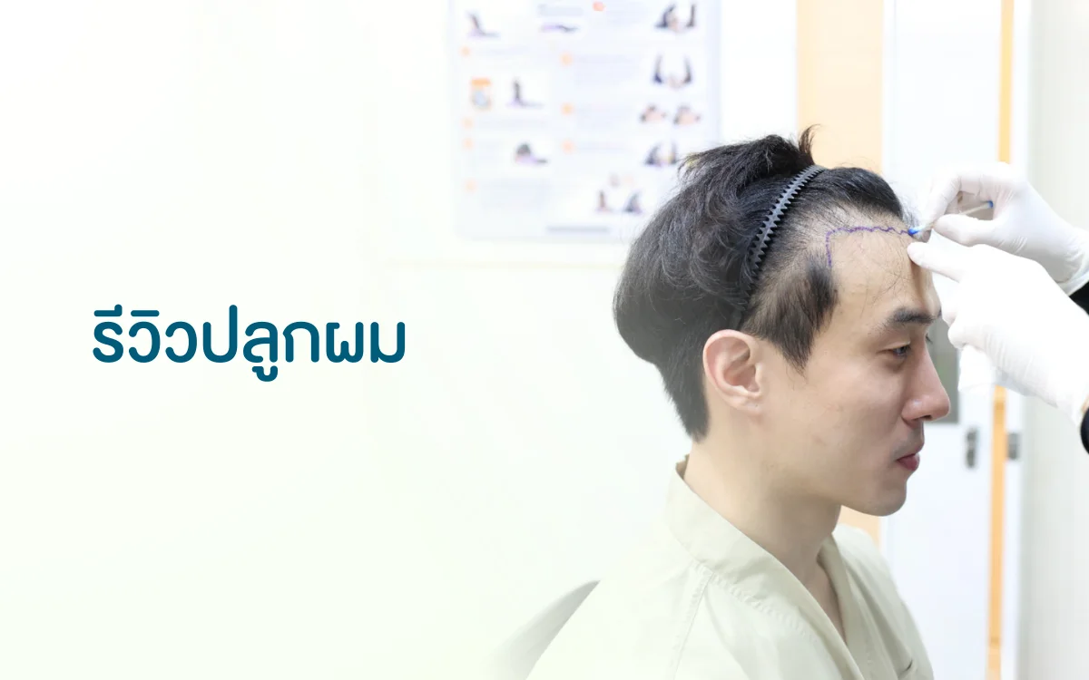 รีวิวปลูกผม