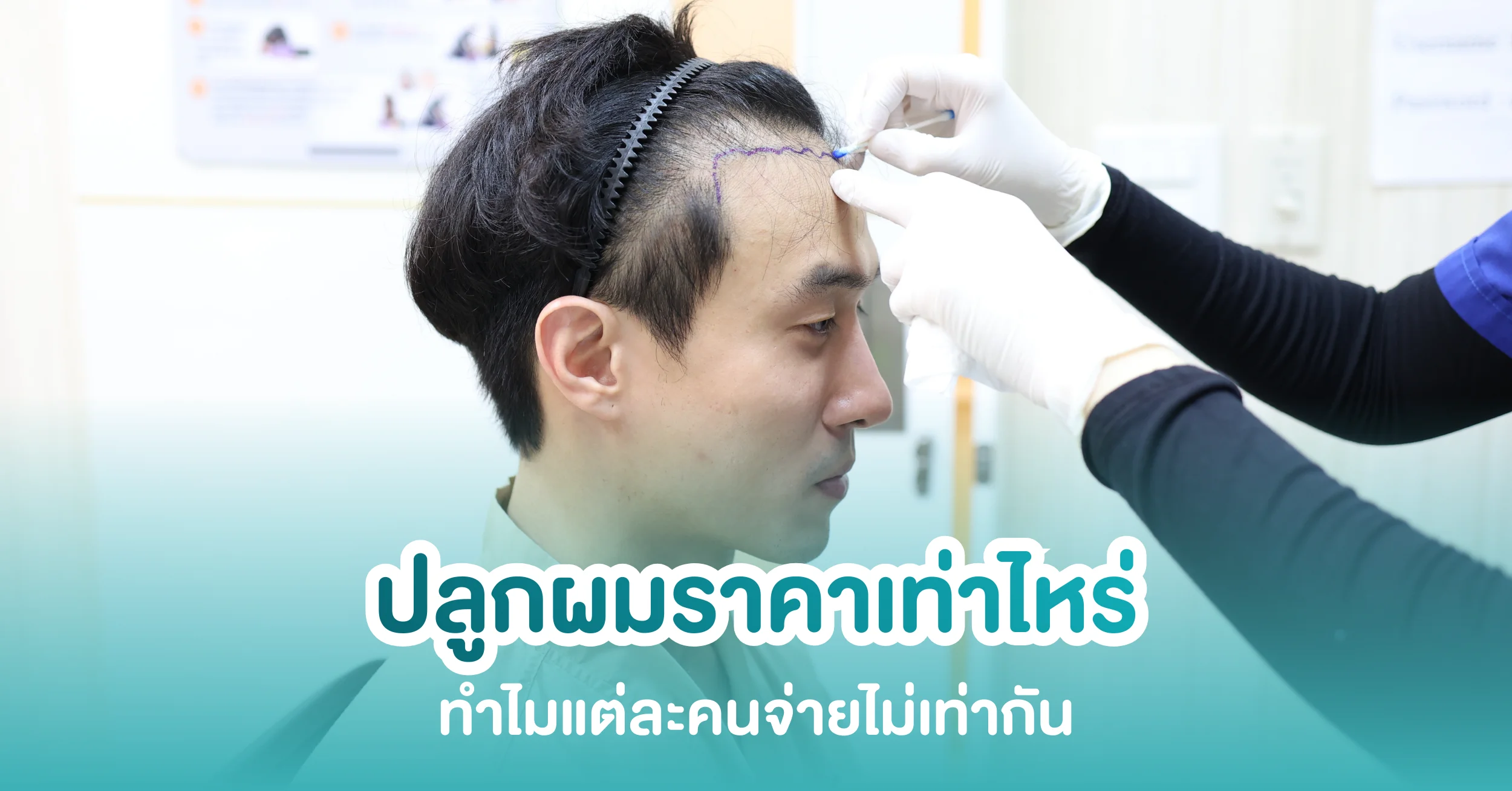 ปลูกผมราคาเท่าไหร่? เช็กค่าใช้จ่าย ทำไมแต่ละคนจ่ายไม่เท่ากัน (อัปเดต 2569)