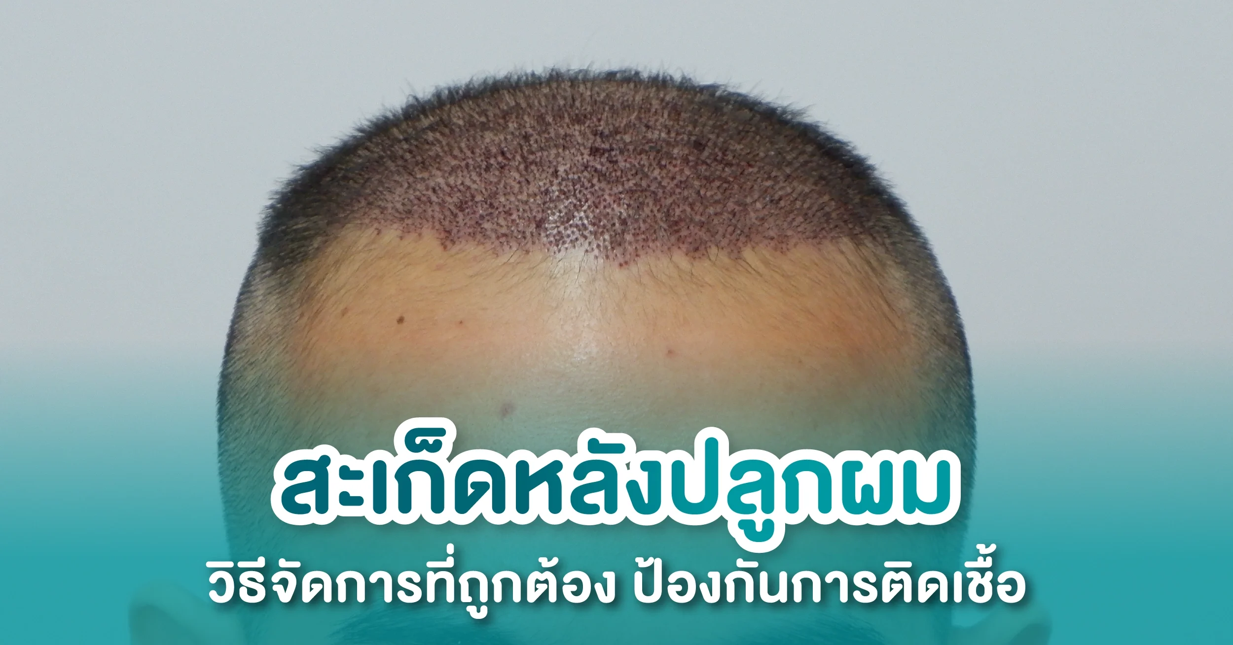 สะเก็ดหลังปลูกผม แกะได้ไหม? กี่วันหาย ทำอย่างไรให้สะเก็ดหลุดออก