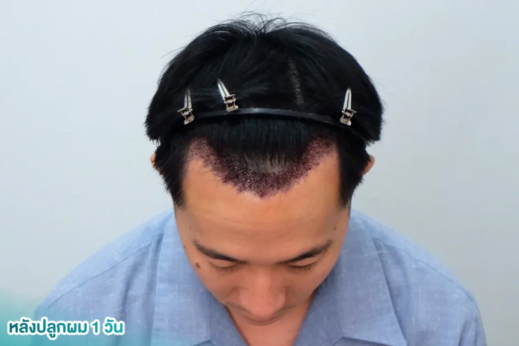 สะเก็ดแผลหลังปลูกผม 1 วัน