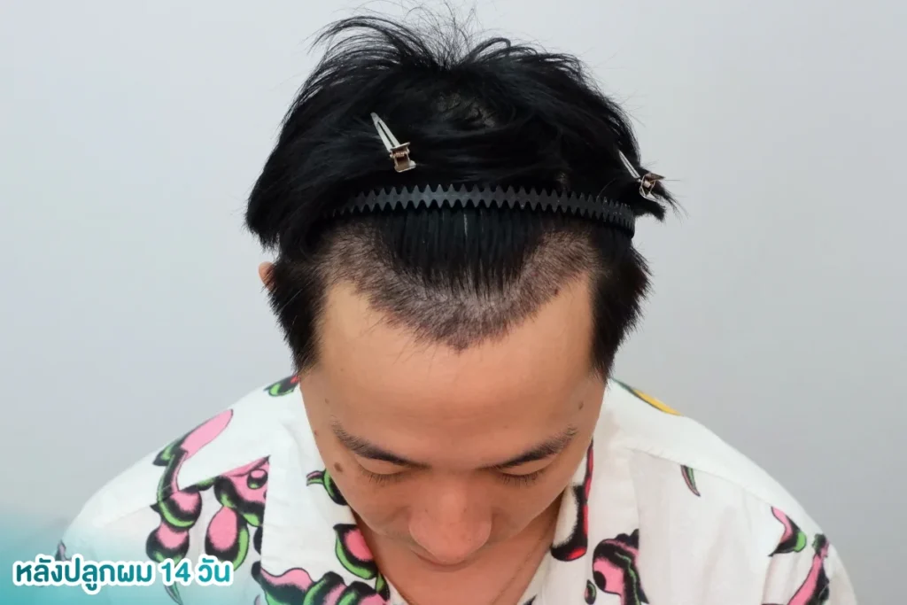 สะเก็ดแผลหลังปลูกผม กี่วันหาย แกะได้ไหม