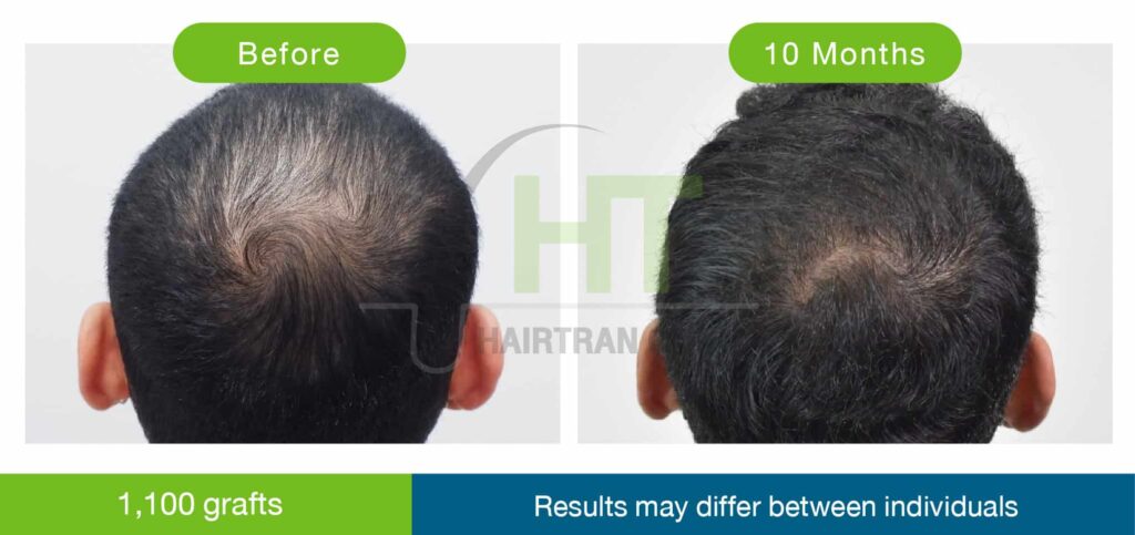 ปลูกผมกลางศีรษะ 1100 กราฟท์