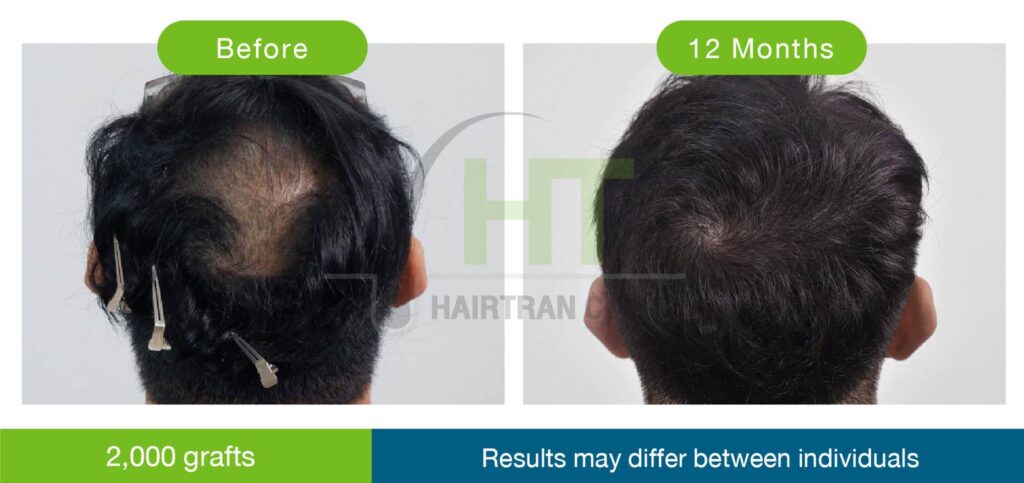 ปลูกผมกลางศีรษะ 2500 กราฟท์