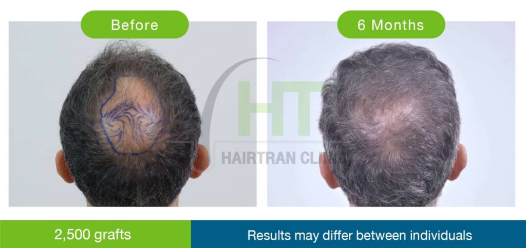 ปลูกผมกลางศีรษะ 2500 กราฟท์