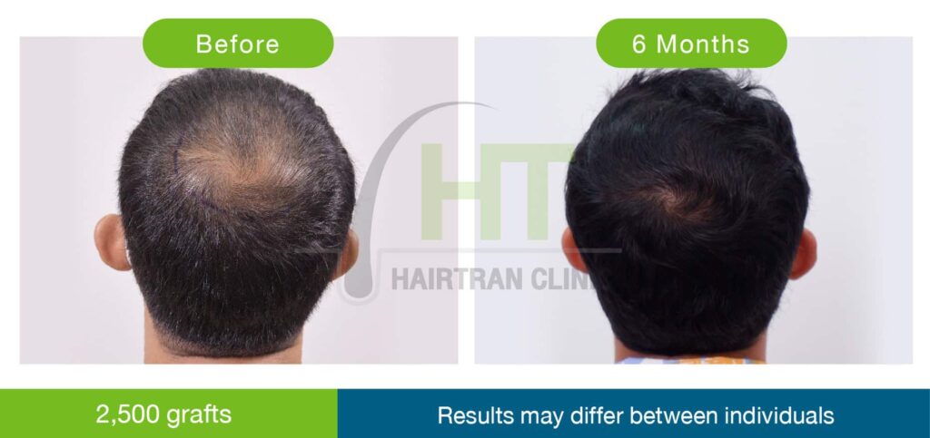 ปลูกผมกลางศีรษะ 2500 กราฟท์