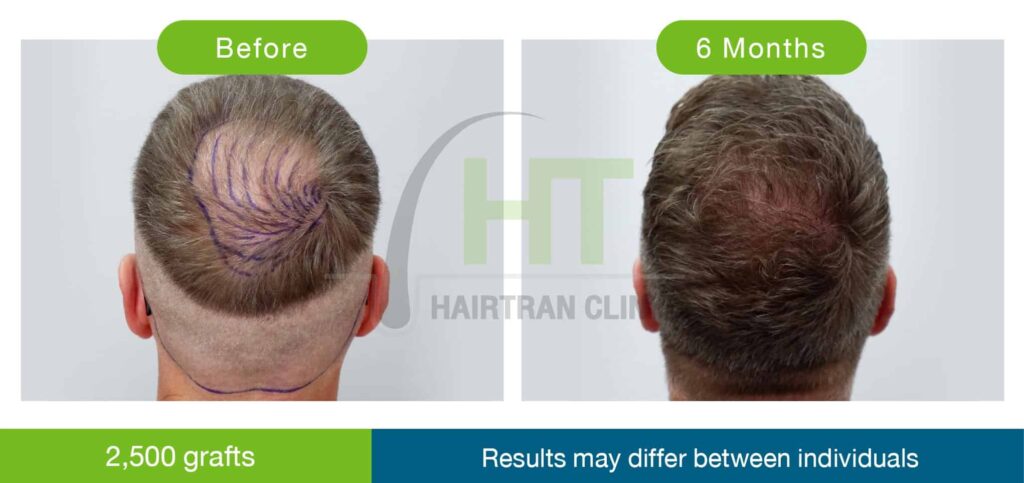 ปลูกผมกลางศีรษะ 2500 กราฟท์