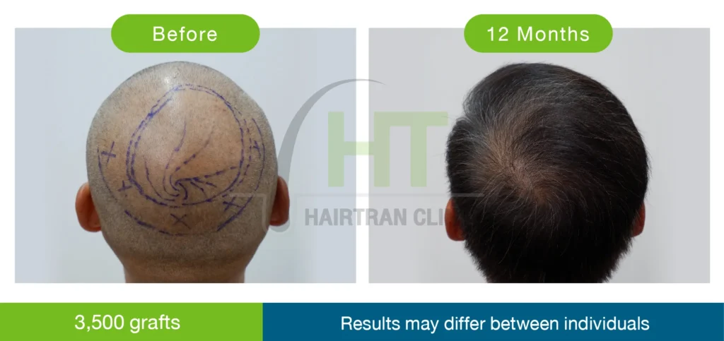 ภาพปลูกผมกลางศีรษะ 2900 กราฟท์