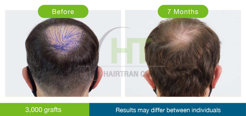 ปลูกผมกลางศีรษะ 3000 กราฟท์
