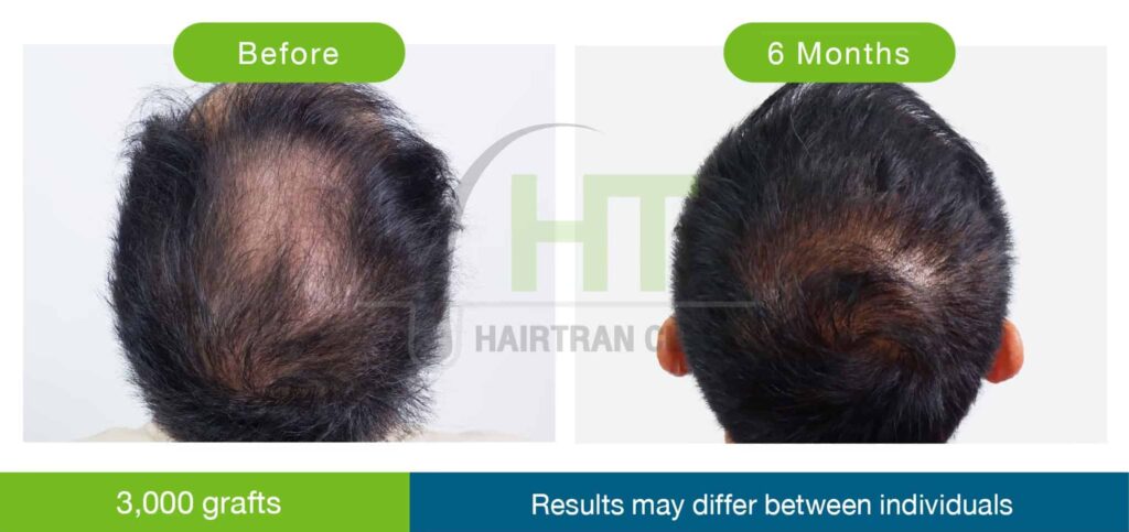 ปลูกผมกลางศีรษะ 3000 กราฟท์