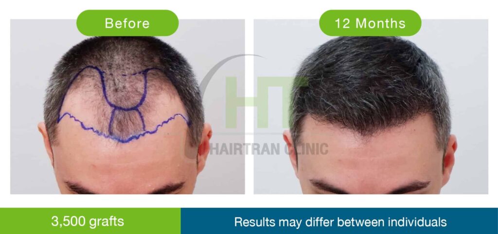 ปลูกผมผู้ชาย 12 เดือน 3500 กราฟท์