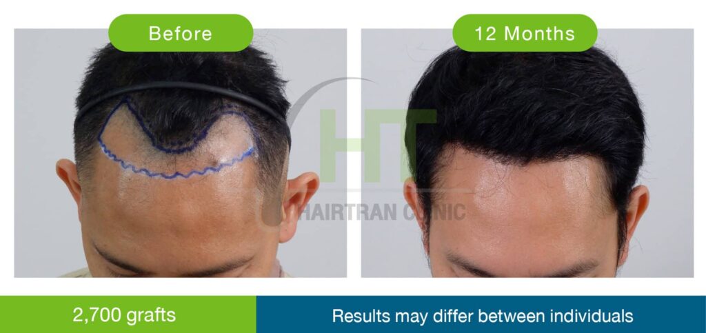 ปลูกผมผู้ชาย 12 เดือน 2700 กราฟท์