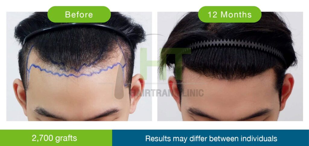 ปลูกผมผู้ชาย 12 เดือน 2700 กราฟท์