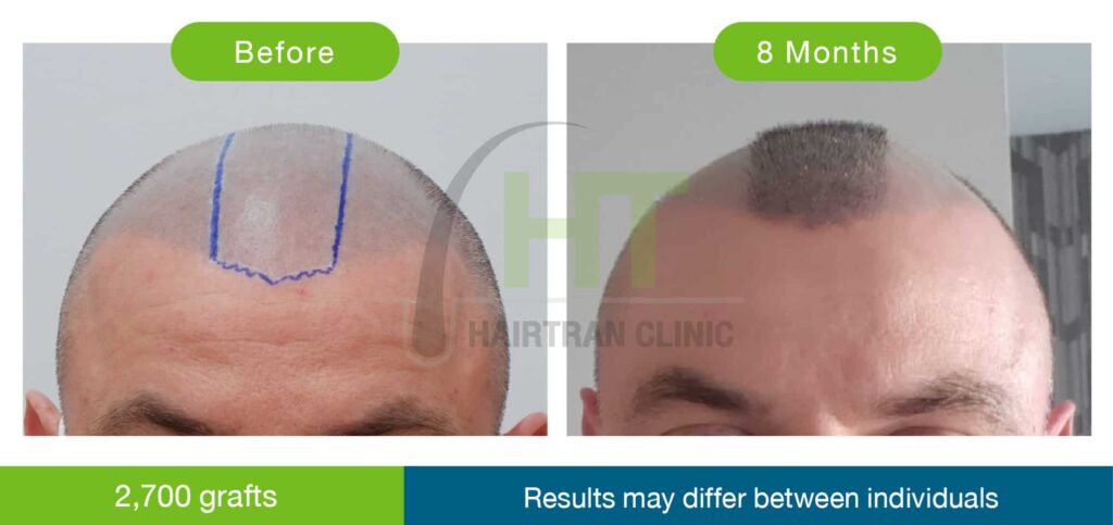 ปลูกผมผู้ชาย 8 เดือน 2700 กราฟท์