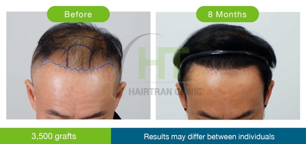ปลูกผมผู้ชาย 8 เดือน 3500 กราฟท์