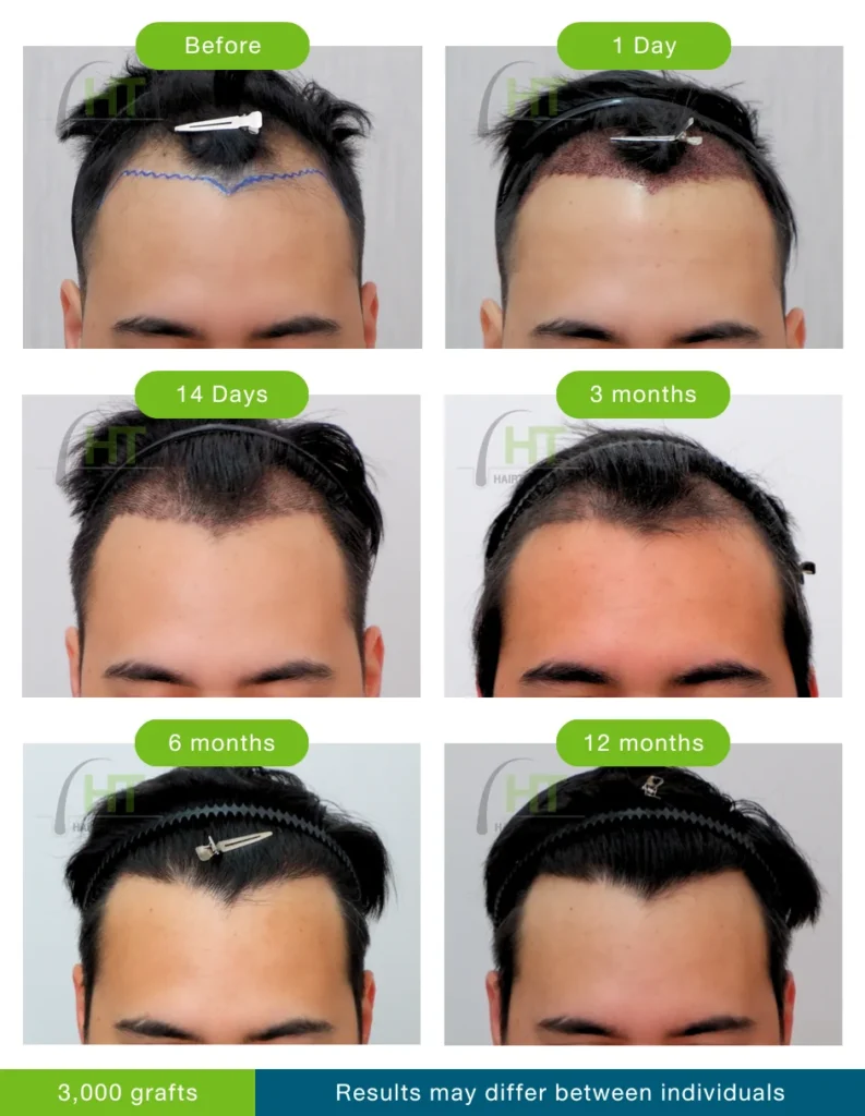 รีวิวปลูกผม ผู้ชาย 3000 กราฟท์