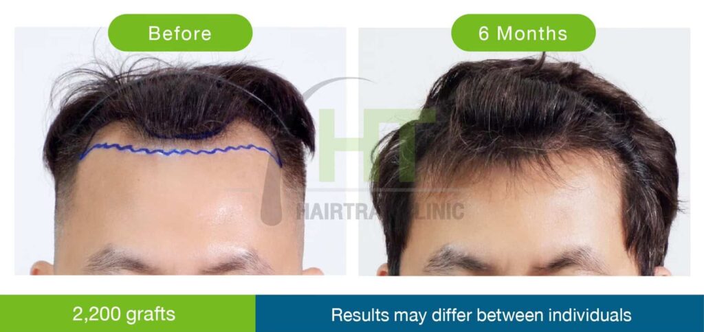 รีวิวปลูกผมผู้ชาย 6 เดือน 2200 กราฟท์