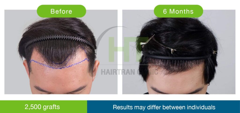 รีวิวปลูกผมผู้ชาย 6 เดือน 2500 กราฟท์