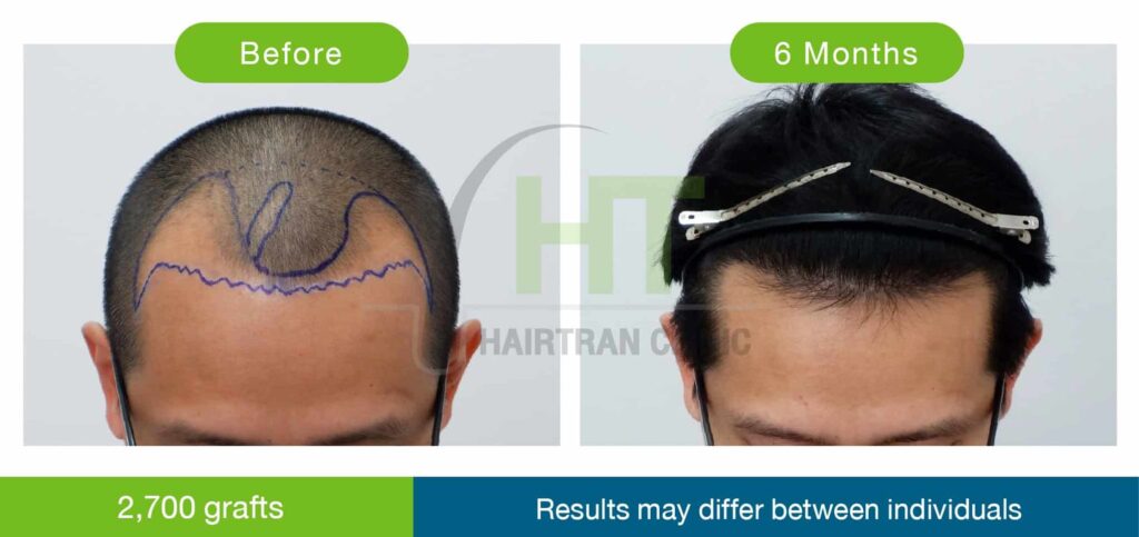 รีวิวปลูกผมผู้ชาย 6 เดือน 2700 กราฟท์