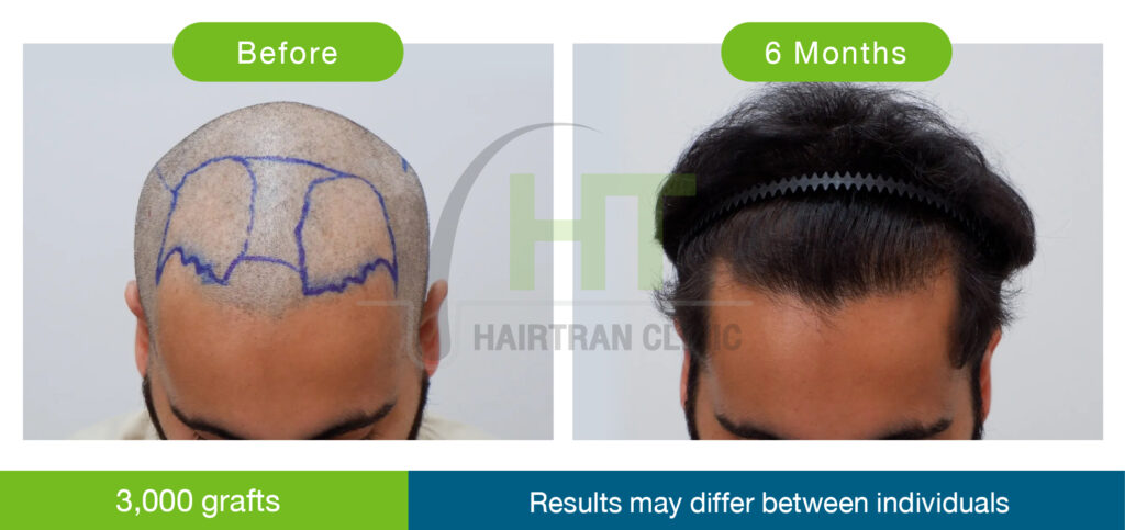 รีวิวปลูกผมผู้ชาย 6 เดือน 3000 กราฟท์