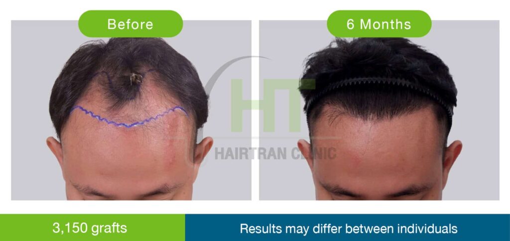 รีวิวปลูกผมผู้ชาย 6 เดือน 3150 กราฟท์