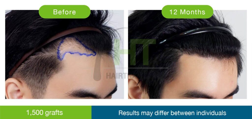 รีวิวปลูกผมมุมข้าง 1500 กราฟท์