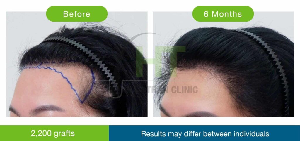 รีวิวปลูกผมมุมข้าง 2200 กราฟท์