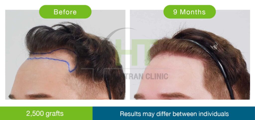 รีวิวปลูกผมมุมข้าง 2500 กราฟท์