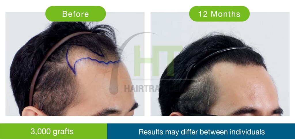 รีวิวปลูกผมมุมข้าง 3000 กราฟท์