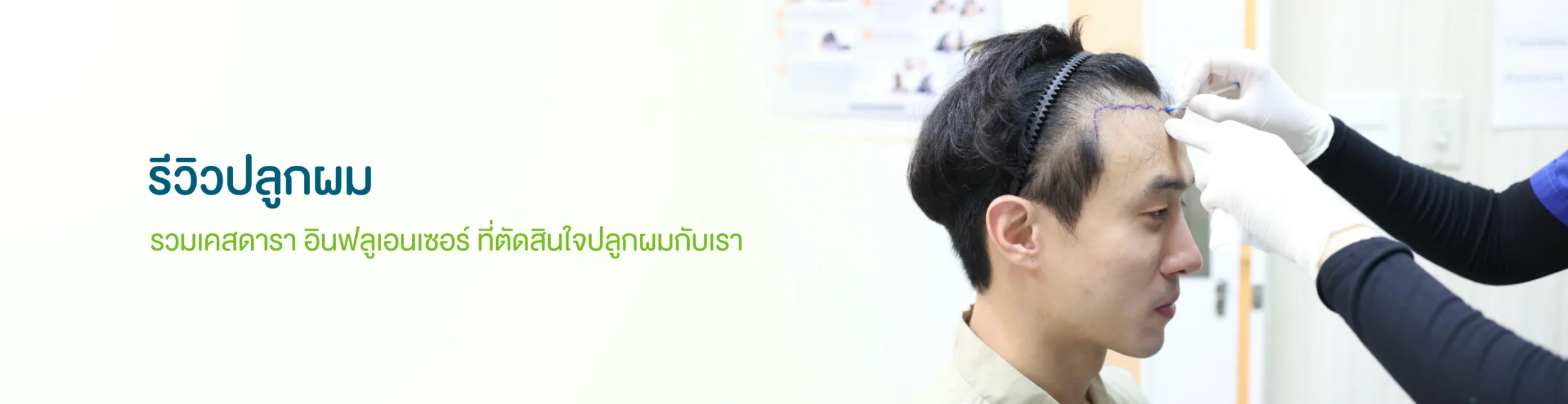 รีวิวปลูกผม