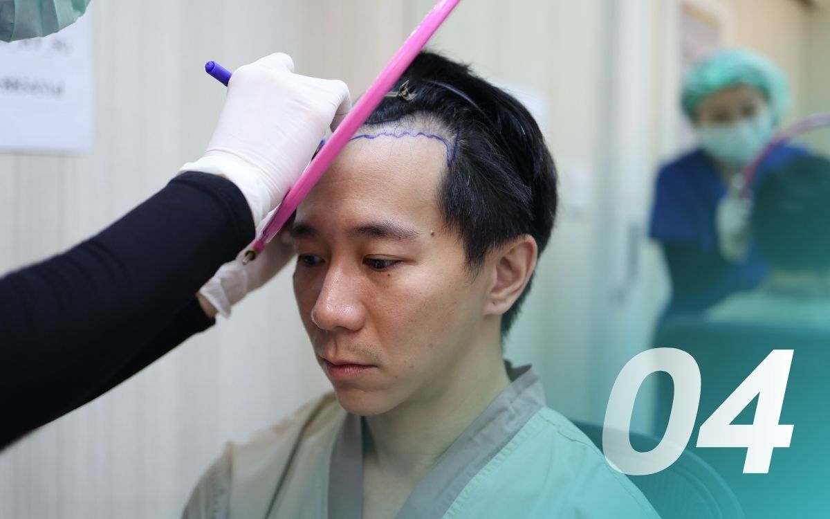 คำถามปลูกผม ปลูกผมราคาเท่าไหร่