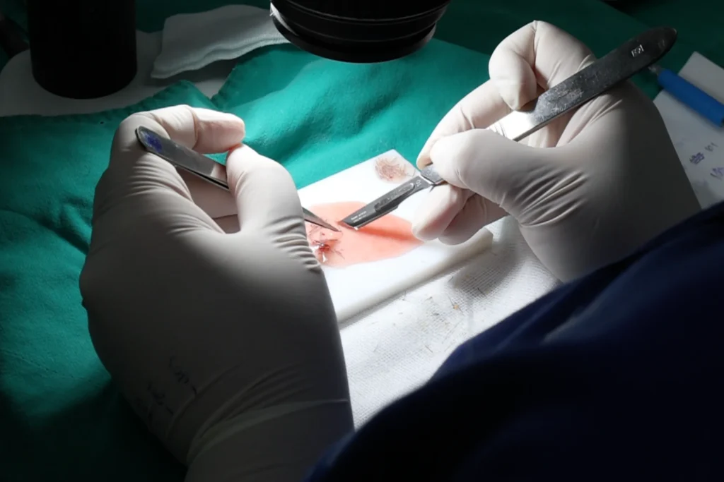 ปลูกผมราคาถูก เสี่ยงกราฟท์ผมเสียหาย