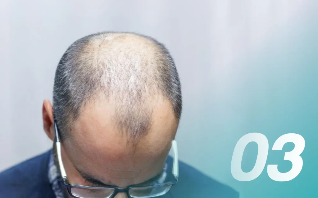 คำถามปลูกผม