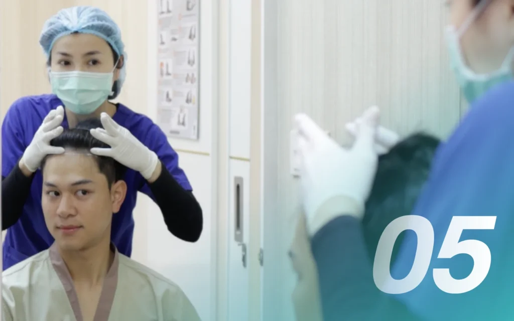 Q&A หลังปลูกผม ต้องพักฟื้นกี่วัน