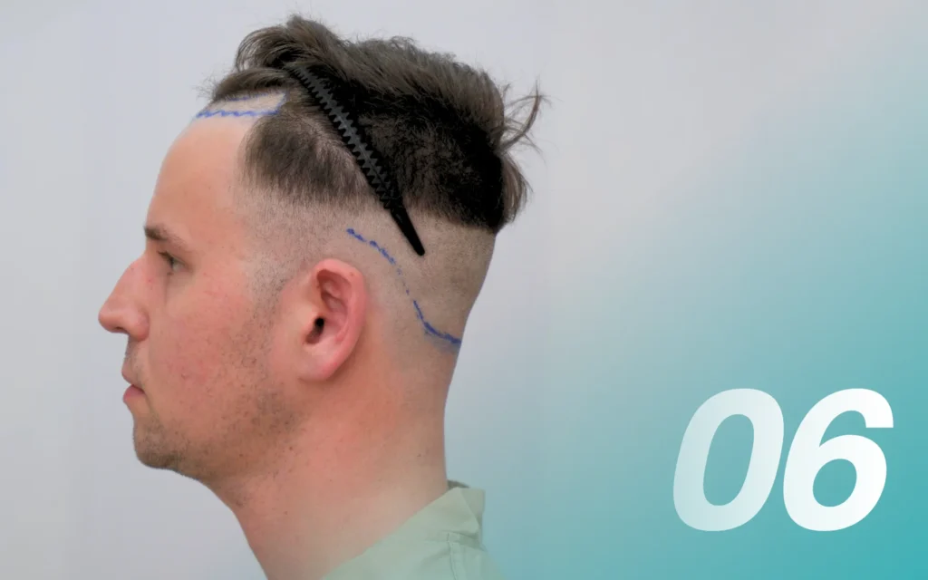 Q&A ทำไมต้องโกนผมก่อนปลูกผม