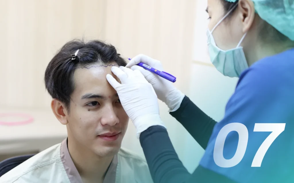 Q&A หลังปลูกผม เห็นผลชัดเจนตอนไหน