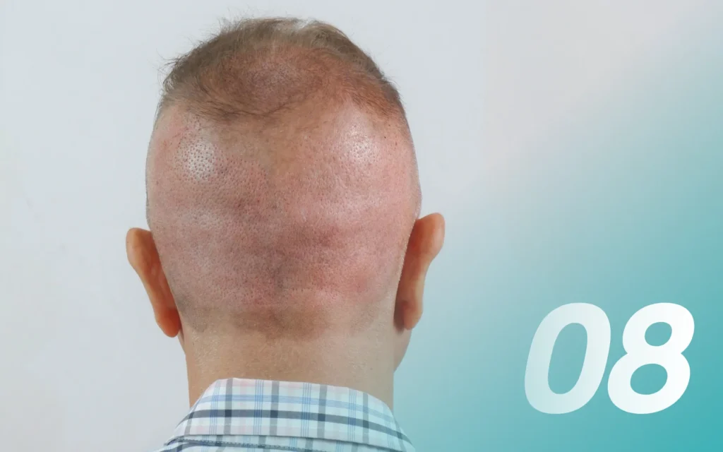 Q&A ปลูกผม มีแผลเป็นไหม