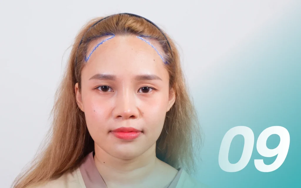 Q&A ผู้หญิงปลูกผมได้ไหม