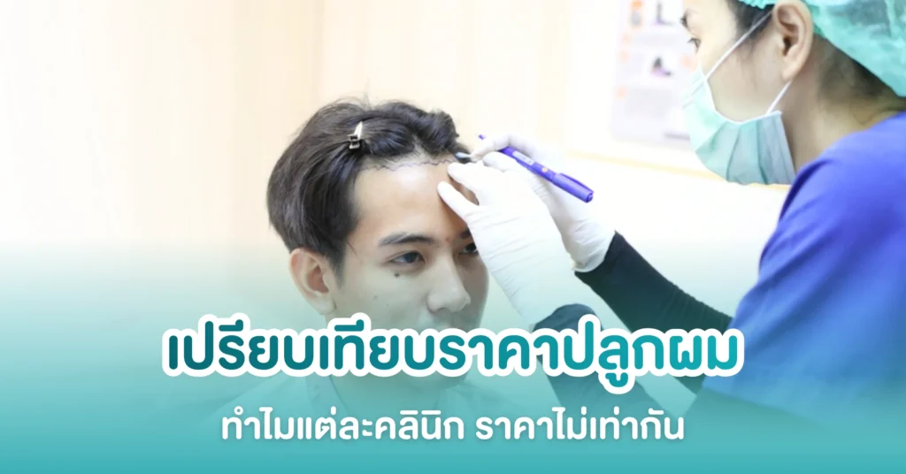 เปรียบเทียบราคาปลูกผม