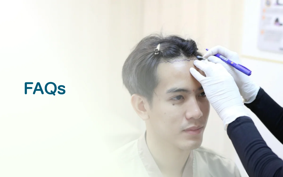 Hair Transplant FAQs