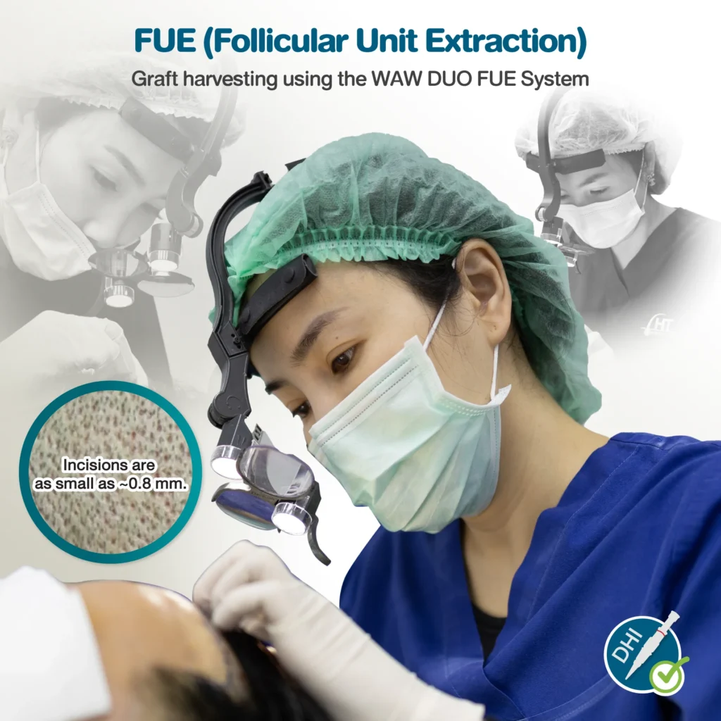 FUE (Follicular Unit Extraction) Hair Transplant