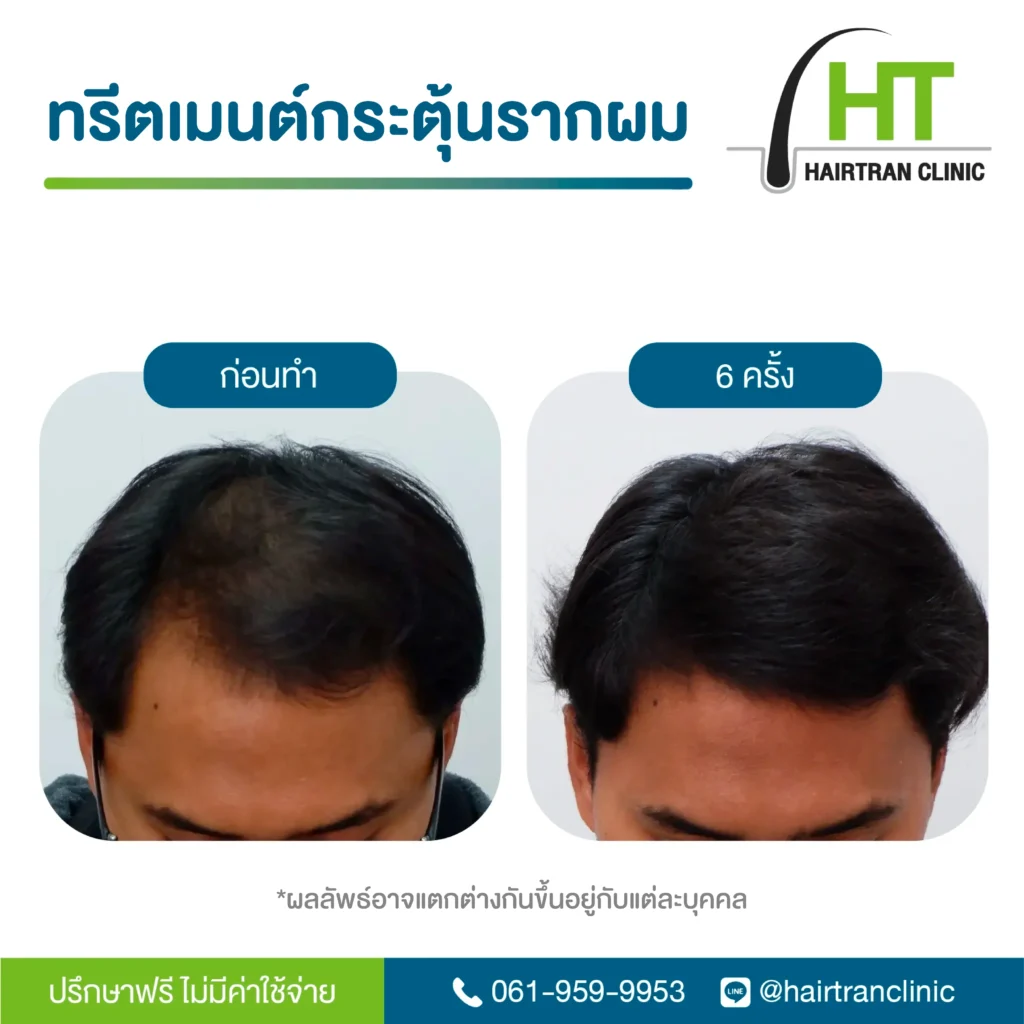 ผลลัพธ์ ฉีดเกล็ดเลือดเข้มข้น กระตุ้นรากผม 6 ครั้ง
